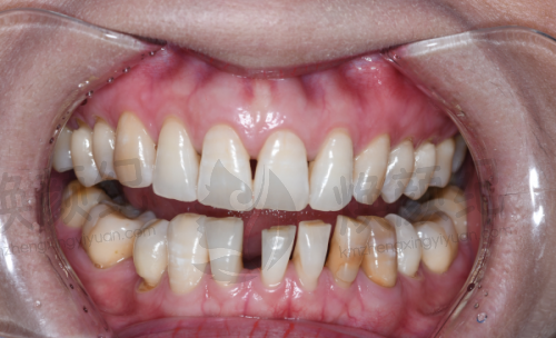 核心区别一:修复原理,一“种”一“镶”大不同