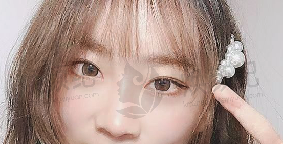 重庆松山医院医学美容科眼皮术后36天恢复效果如何？案例来揭秘