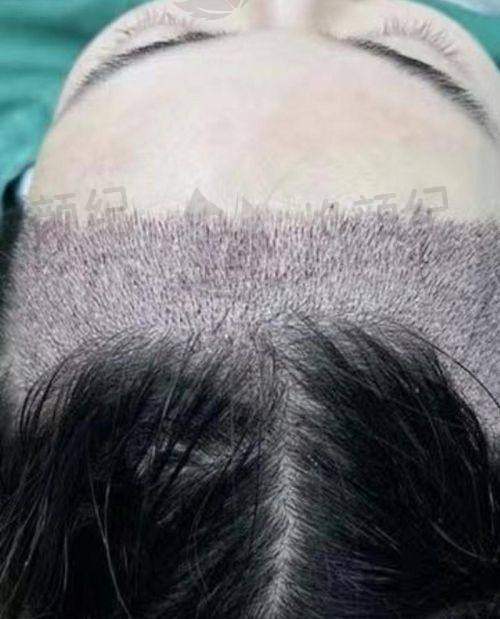 三、刘跃飞医生在医美领域技术特长