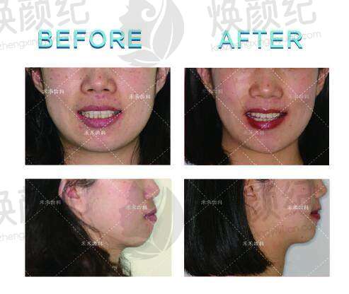 王绍骅做数字化无托槽隐形矫治技术怎么样？