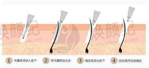 三、金大暎医生在医美领域技术特长